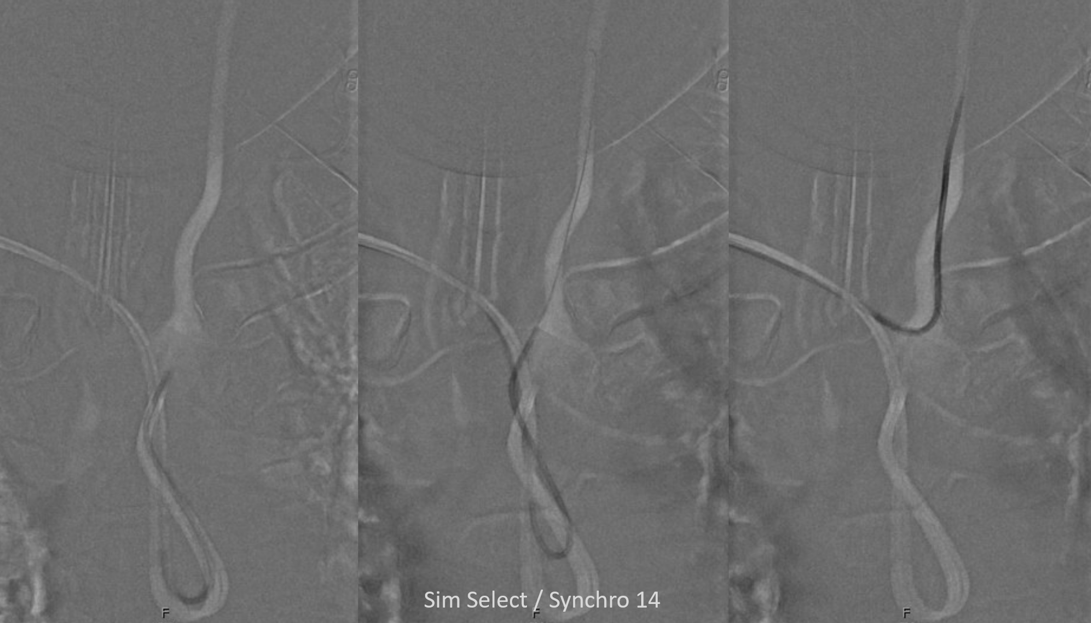 Subdural Embolization Multiple Orbital Anastomoses nBCA Technique